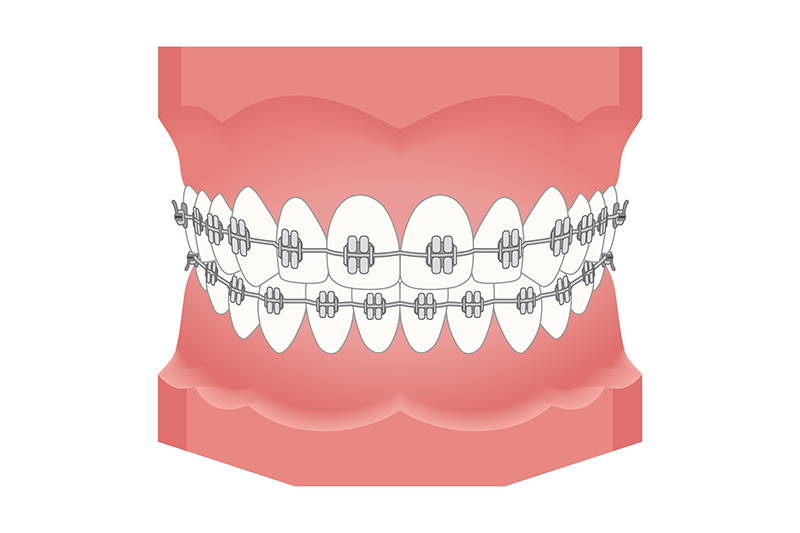 表側矯正・裏側矯正